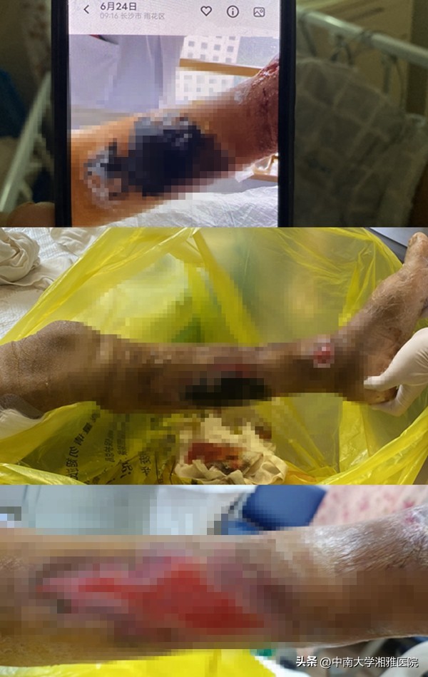 湘雅医院干细胞移植治疗肝衰竭,湘雅医院干细胞治好肝衰竭