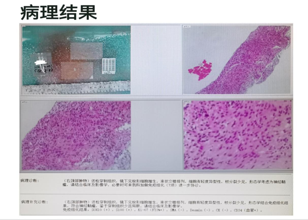 甲状腺癌切除后脖子上有小疙瘩,甲状腺癌切除后留有包膜会转移吗