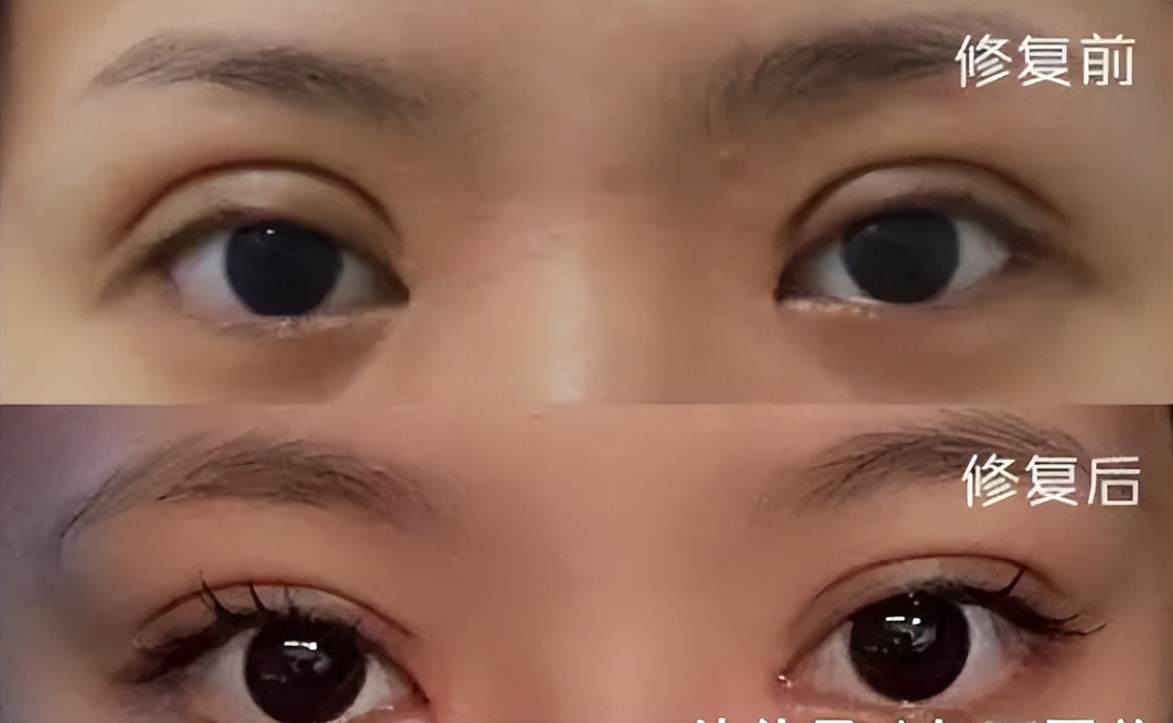 太原割双眼皮好的医院,双眼皮手术失败成内双