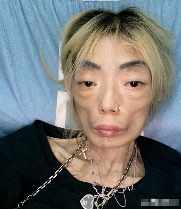 “最惨阔太”伍智恒：嫁豪门8年，换来牙齿全脱，体重仅剩44斤