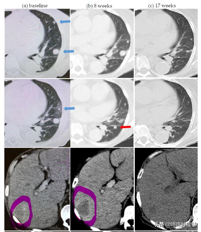 免疫治疗pd-1是输液吗,免疫治疗pd1彻底治好肺癌了吗