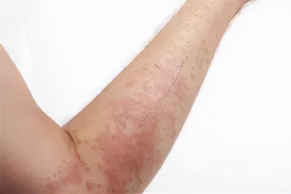 麻疹湿疹荨麻疹三者有什么区别,荨麻疹和湿疹断根的土方法