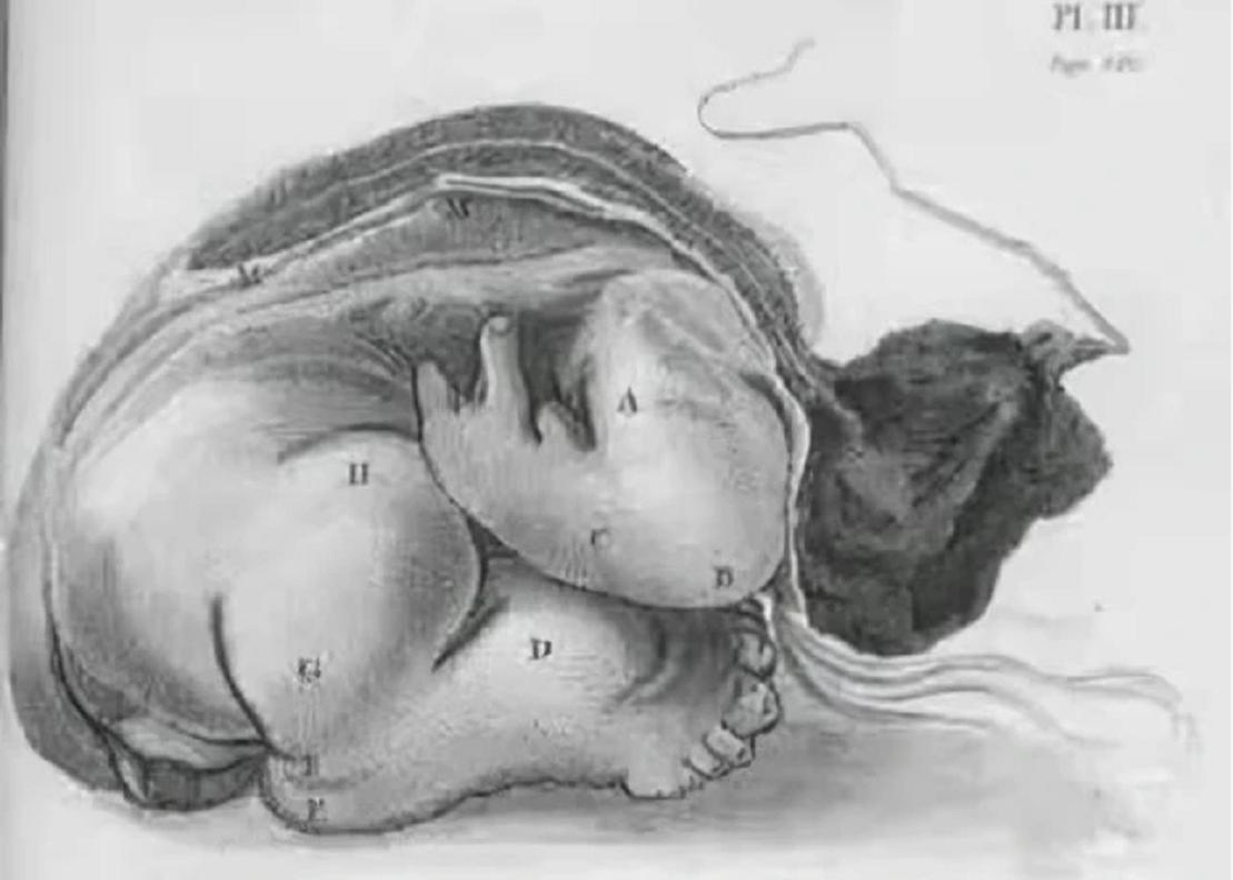 印度女子产下罕见胎中胎,胎中胎真实案例印度