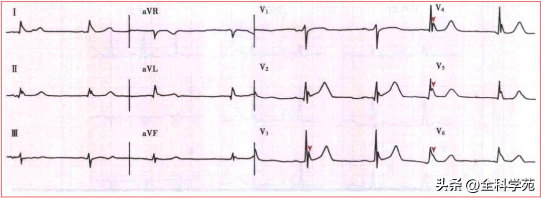 心电图qrs时限超宽严重吗,心电图qrs波形态描述