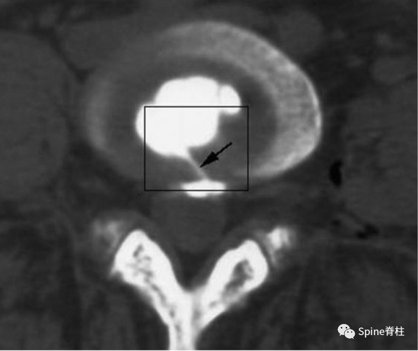 因腰椎问题导致的腰痛,慢性腰骶部疼痛