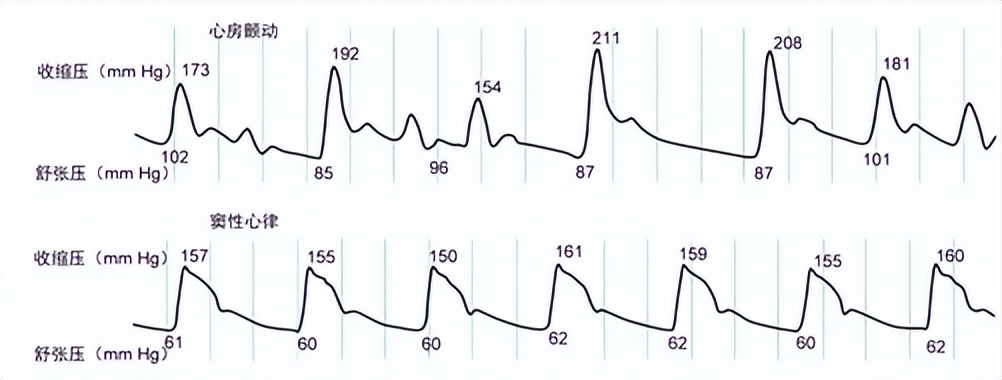 房颤的病人怎么测量血压,房颤者怎么测量血压