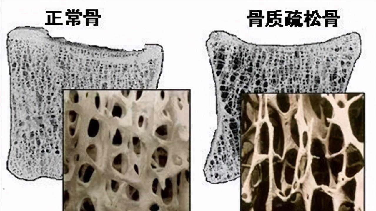 中年人弯腰驼背怎样引起的,老年人弯腰驼背是正常现象