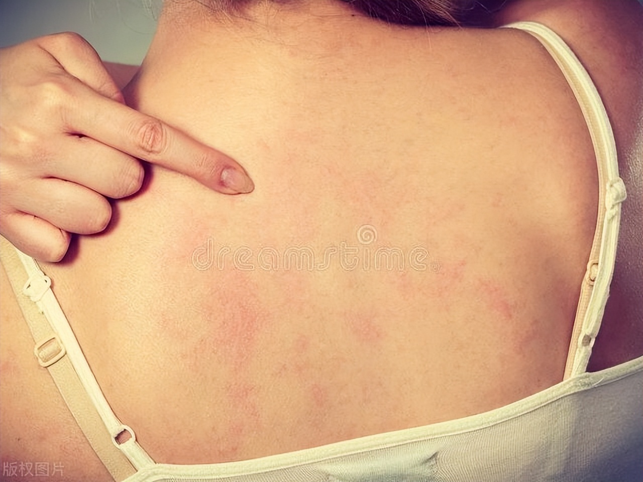 蚊虫叮咬引起的荨麻疹怎么引起的,蚊虫叮咬引起的丘疹性荨麻疹咋办