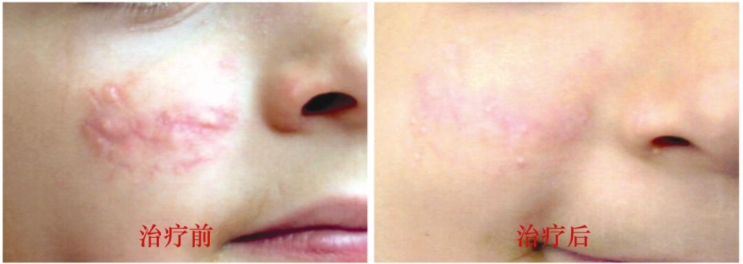 做祛红激光治疗疤痕后的护理,pdl激光治疗红血丝效果好吗