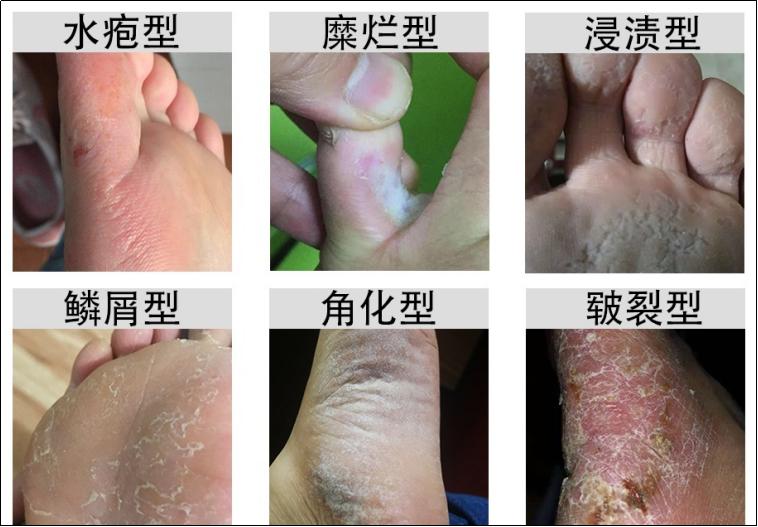 治脚气加盟店,治脚气的加盟店