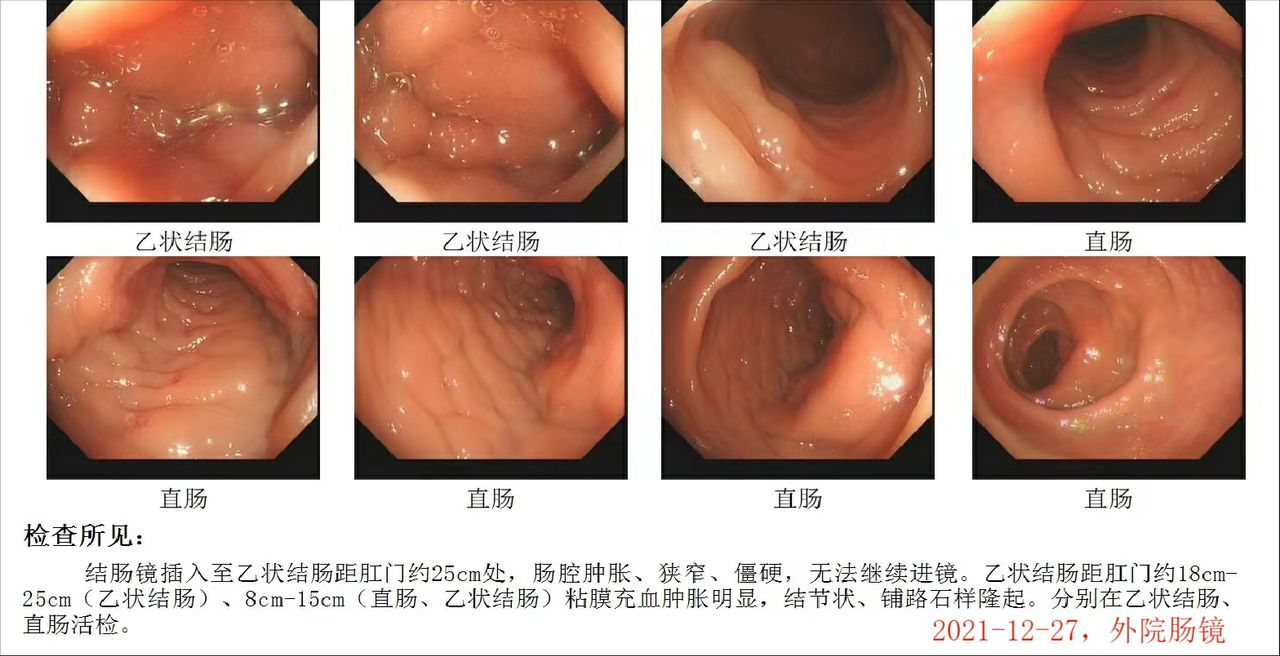 克罗恩肠粘连肠瘘能自愈吗,克罗恩出现肠瘘如何治疗