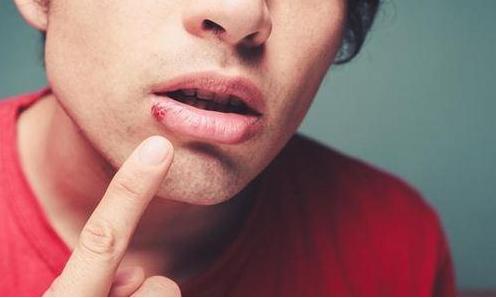 嘴巴旁边很多小水泡会留疤吗,嘴巴周围长一堆小水泡是上火吗