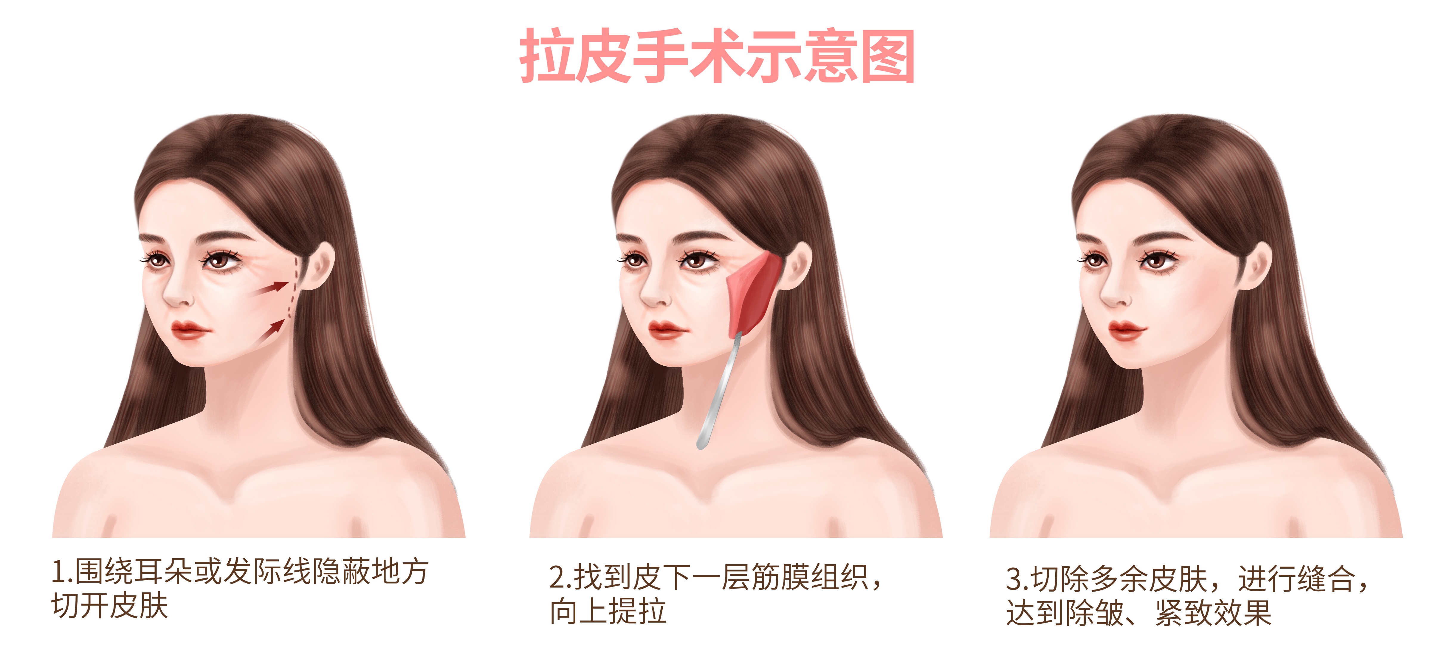 拉皮抗衰老最多能做几次,拉皮和青春定格哪个抗衰老效果好