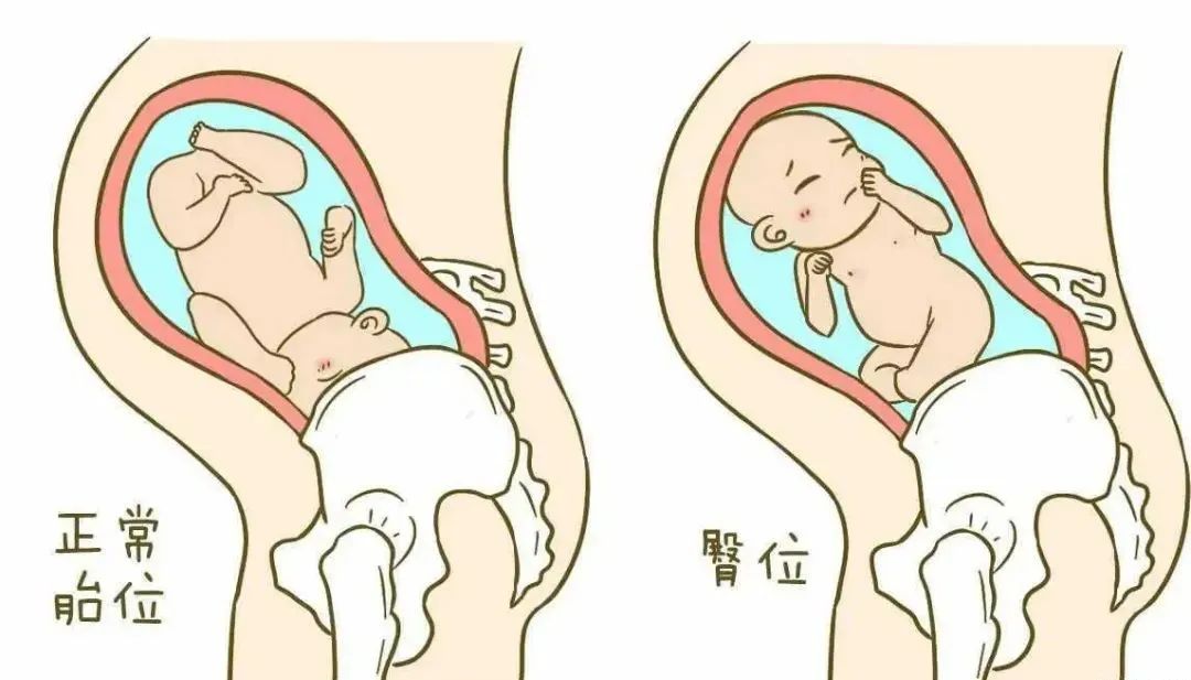 脐带绕颈胎位不正可以顺产吗,胎位不正脐带绕颈能做胸膝卧位