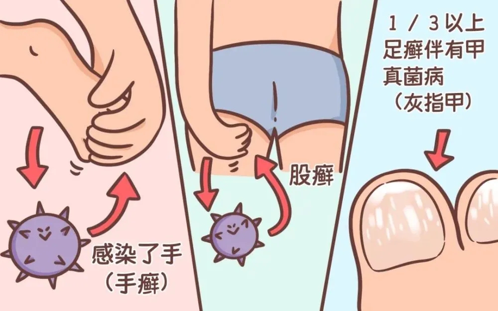 男人股癣会传染给女方会怎样,男生有股癣怎么避免传染给女朋友