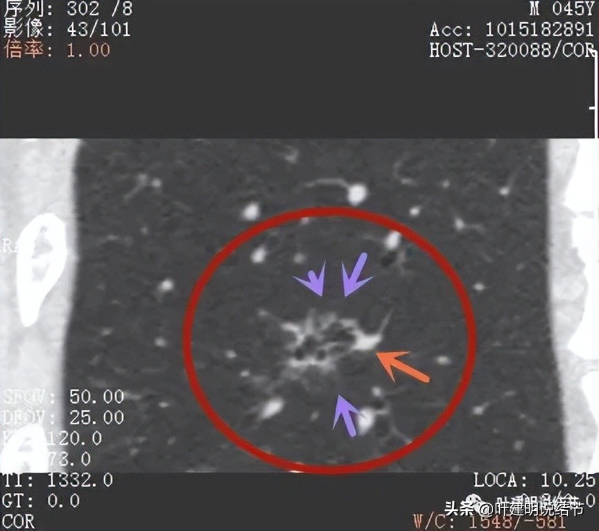 肺蜂窝状改变是肺癌吗,肺部陈旧灶与肿瘤怎么确诊