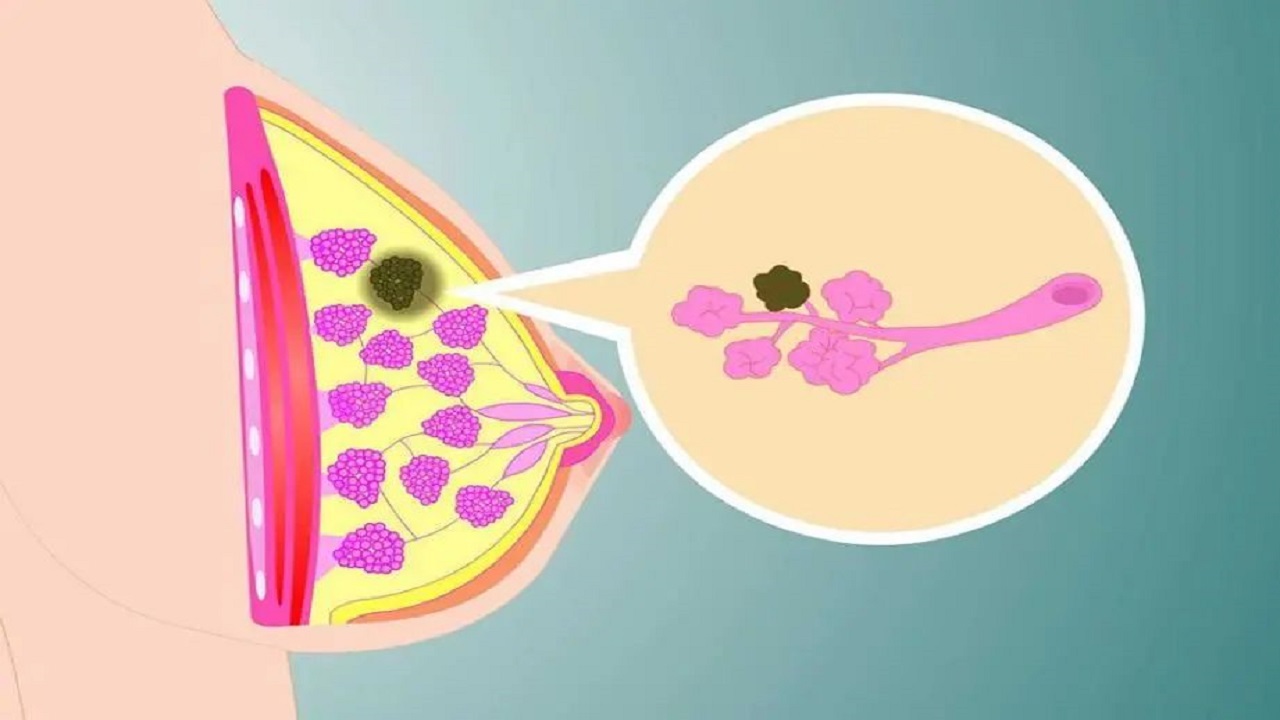 检查乳腺结节4类什么意思,乳腺结节手术是微创好还是开刀好
