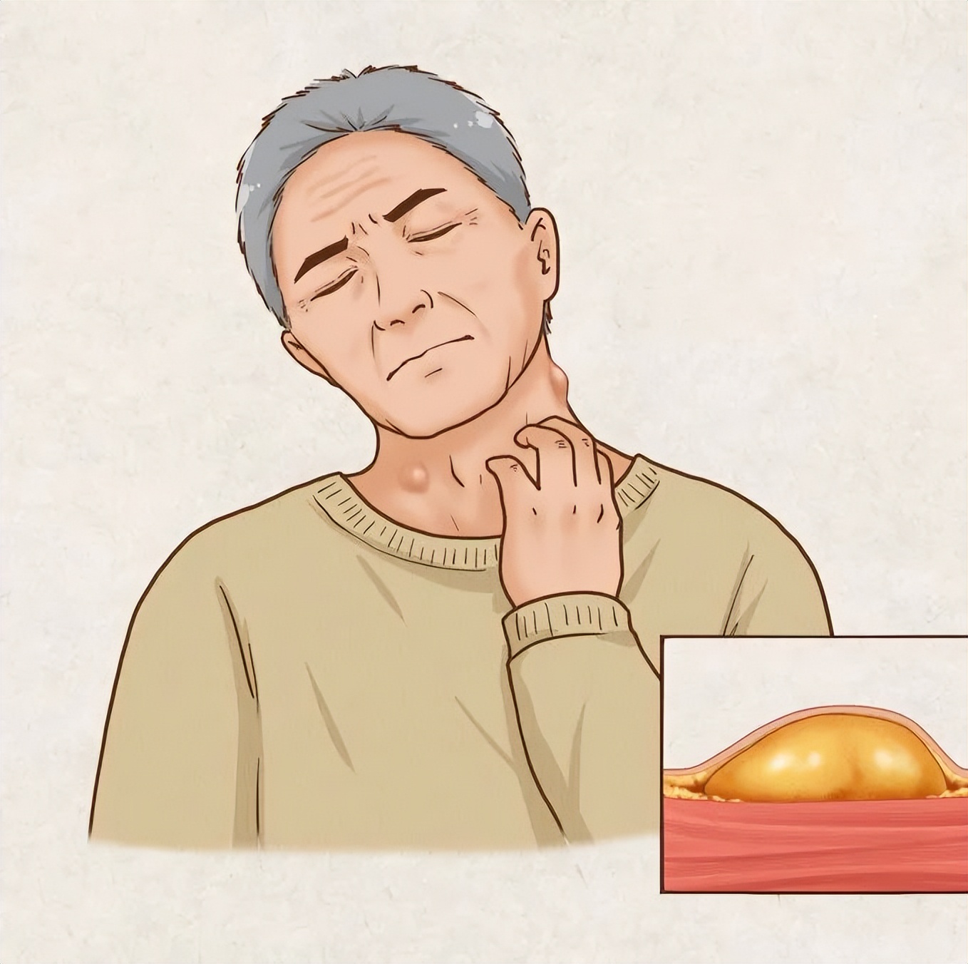 神经外科切除头皮脂肪瘤,脂肪瘤外科门诊手术