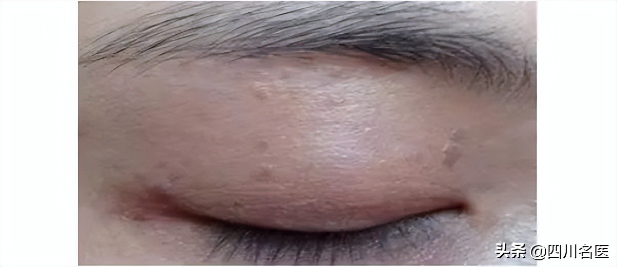眼睛下面的粟丘疹能去掉吗,眼睛周围长的小米粒是啥