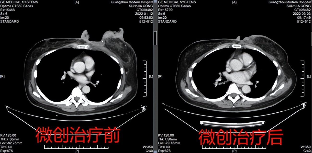 乳腺癌复发腐烂不结疤怎么办,乳腺癌溃烂但肿块缩小