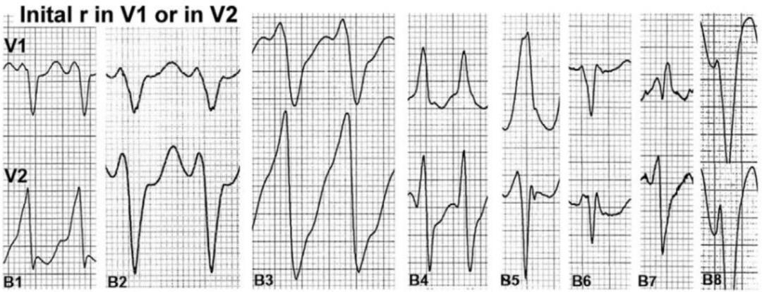 心电图上表现为宽qrs波,心电图中qrs是代表心动过速吗