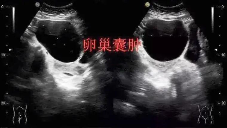 得卵巢囊肿不想手术治疗，中医软坚散结、化痞消积，囊肿慢慢消失