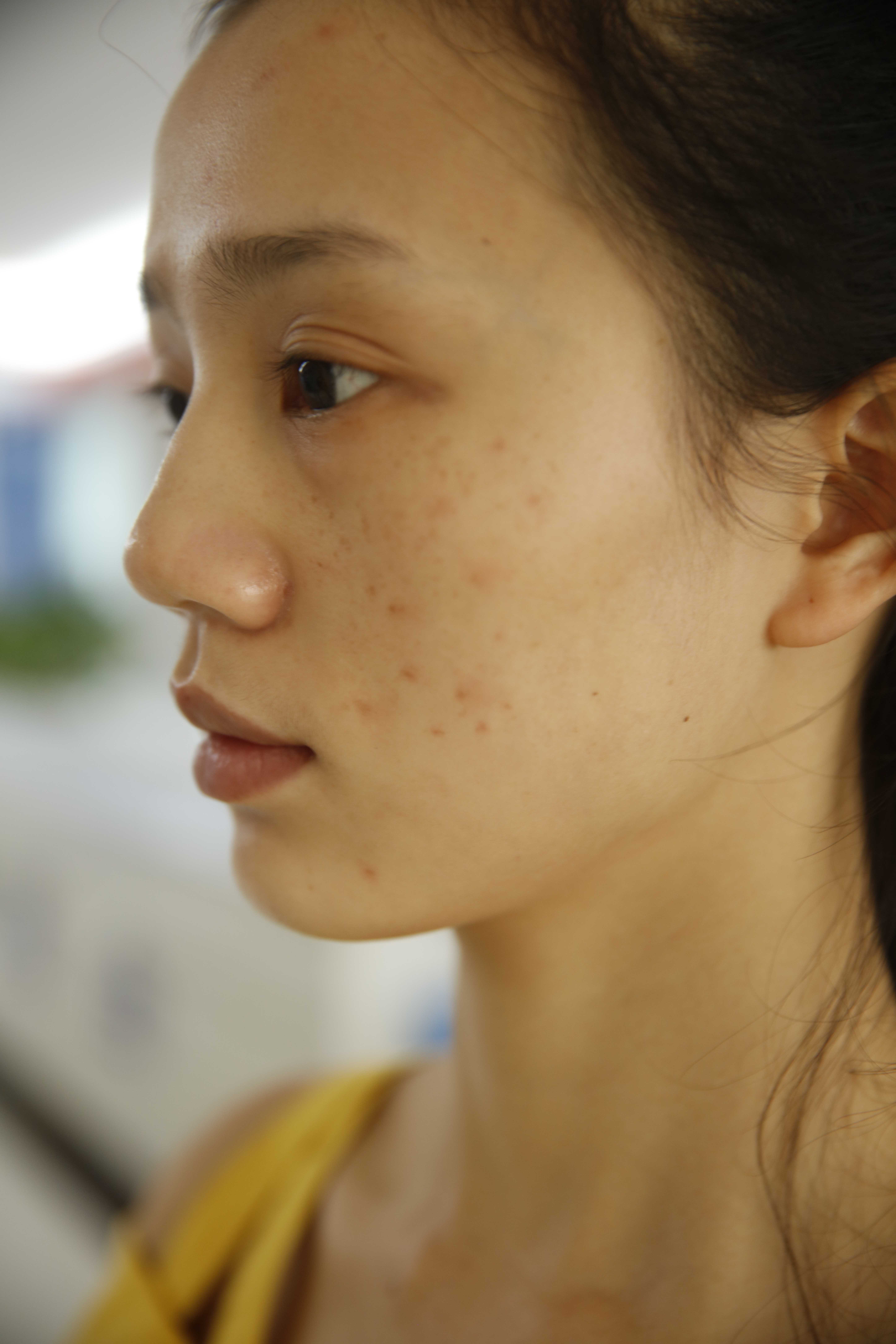 再漂亮的小姐姐也会被痘印困扰，治疗完后感叹激光治疗效果真不错