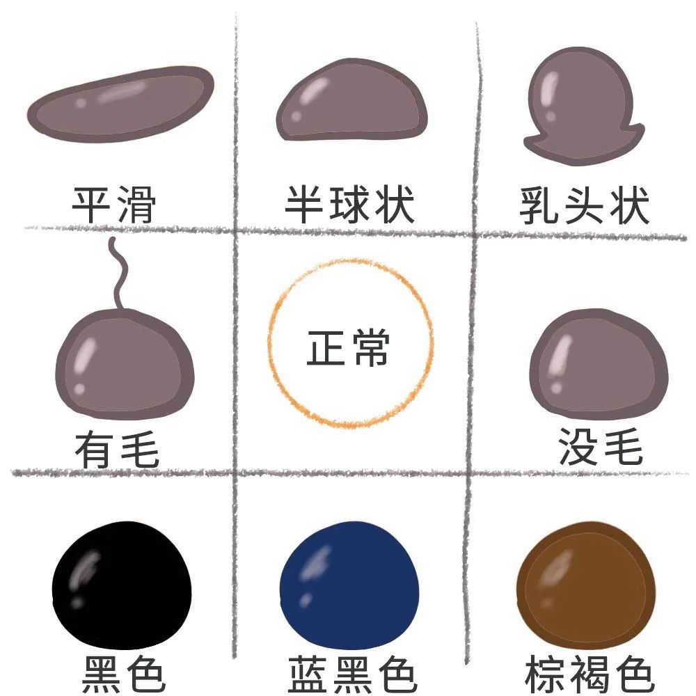 黑痣一旦出血会是恶变吗,黑痣癌变会有什么症状