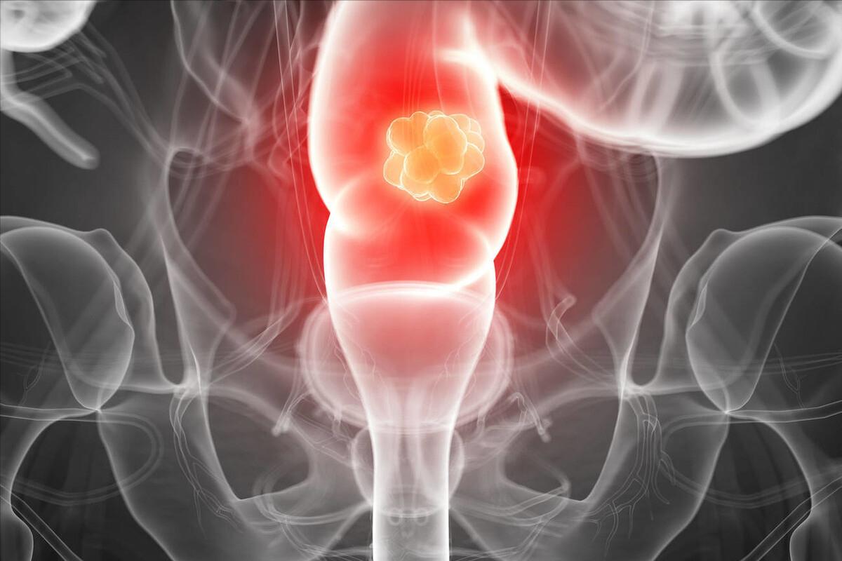 一直感觉大便拉不干净是怎么回事,大便感觉老是拉不干净是什么原因