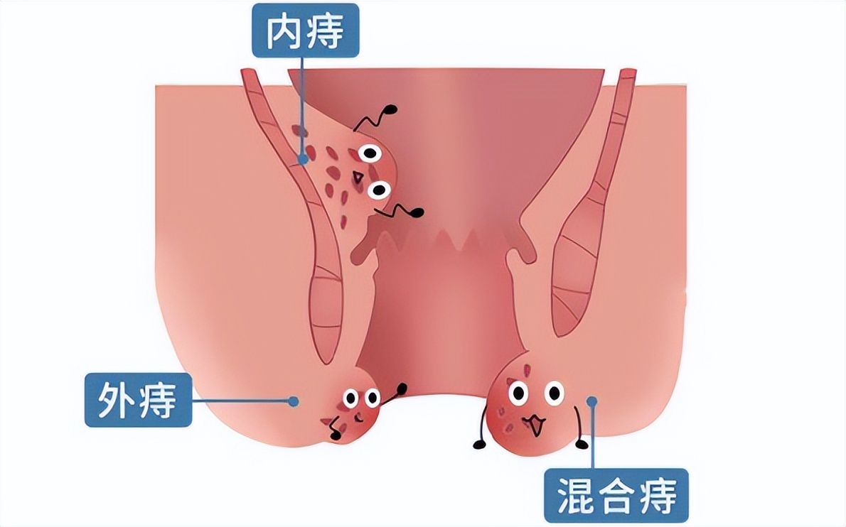 你有“洗肛门”的习惯吗？洗错或比不洗更麻烦，4个细节要重视