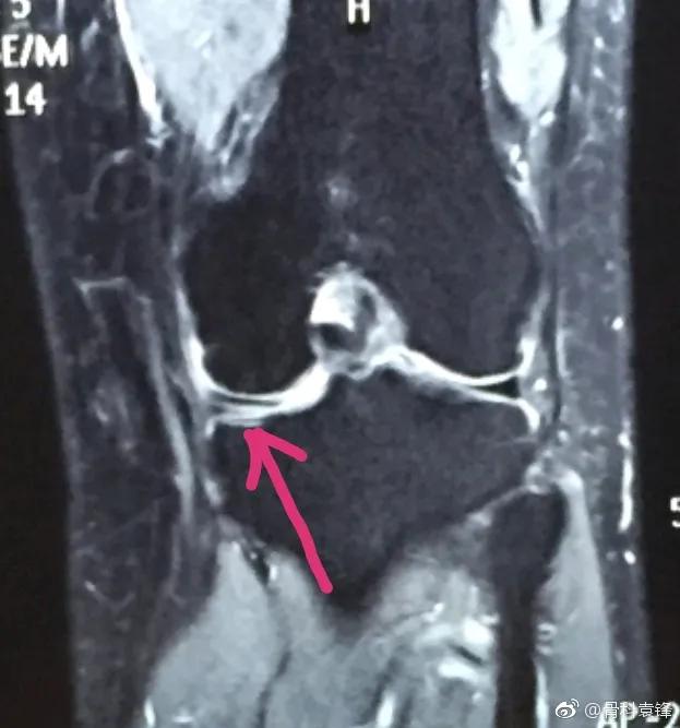 膝关节半月板损伤怎么治疗,膝关节半月板损伤能跑步吗