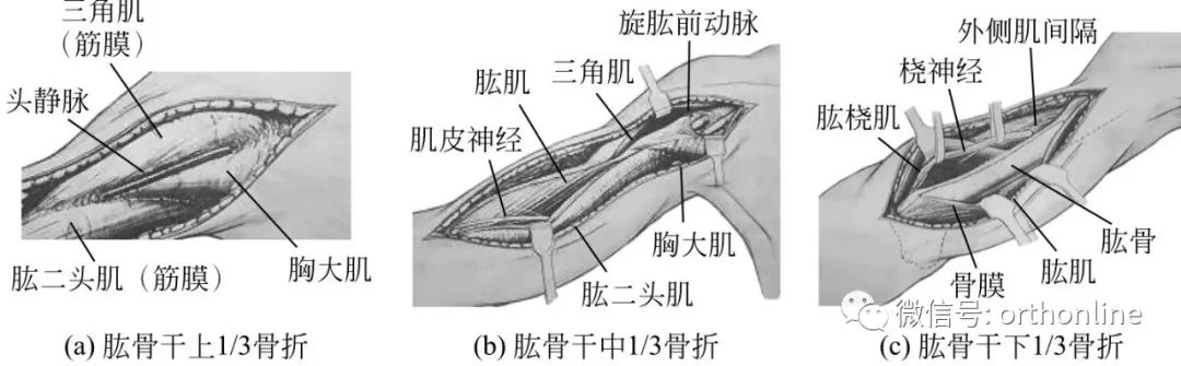 股骨干骨折保守治疗多久恢复,肱骨干骨折恢复过程中的四大禁忌
