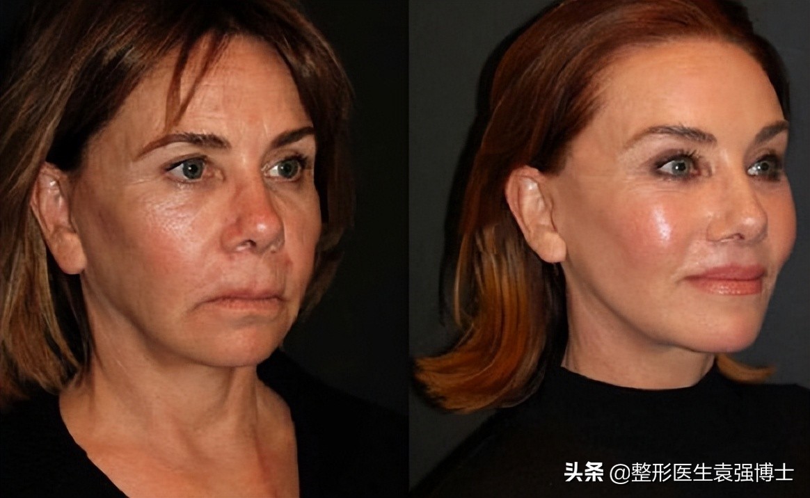 拉皮手术那么危险为什么还有人做,拉皮手术的真实感言