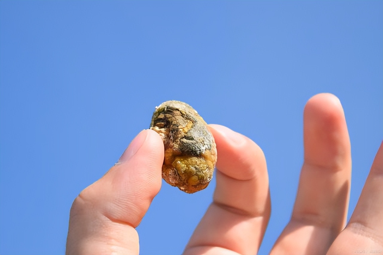 怀孕后得了胆结石是怎么回事,怀孕后为什么容易得胆结石