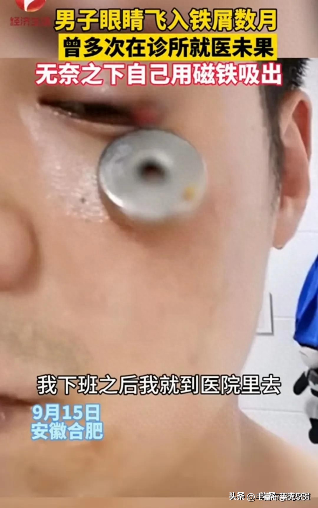男子眼睛进铁屑抖音,男子铁屑进眼数月诊所就医未果