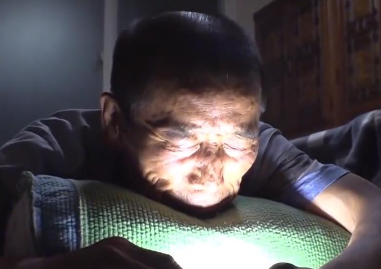 韩国大爷脑袋里有蜘蛛后续,72岁大叔脑里有蜘蛛