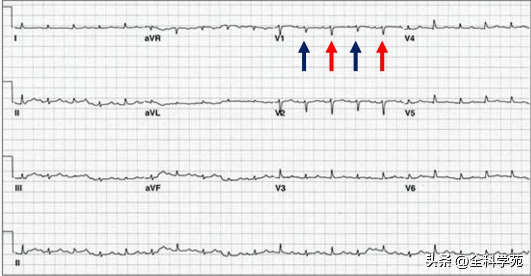 心电图qrs时限超宽是什么引起的,心电图qrs波呈m型见于什么疾病