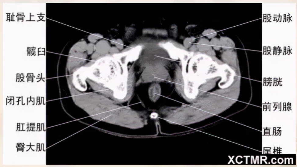 胸腹部盆腔ct主要检查什么,女性盆腔ct断层解剖结构图