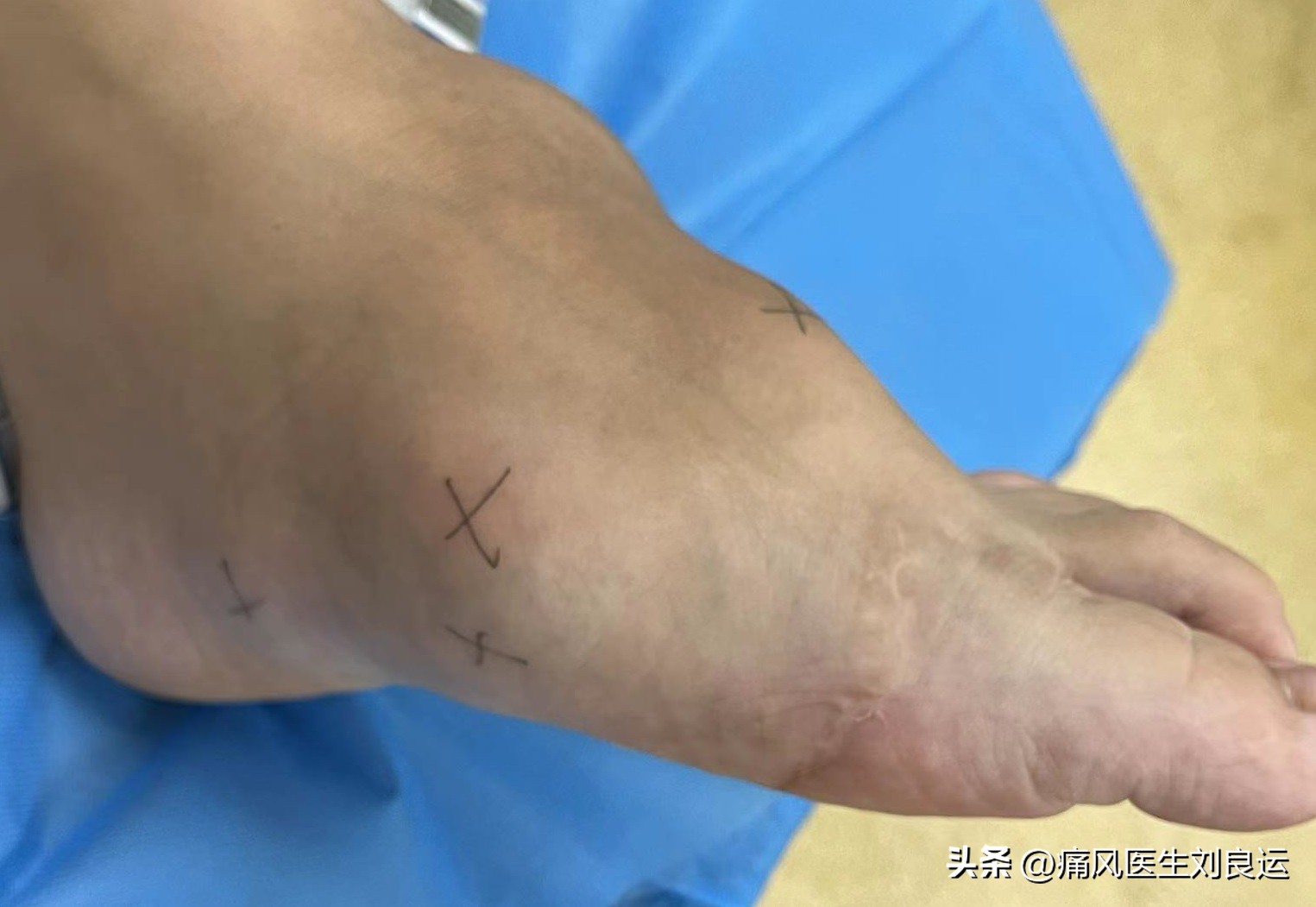 痛风病人用什么方法能治好痛风,痛风治疗最好的方法有什么