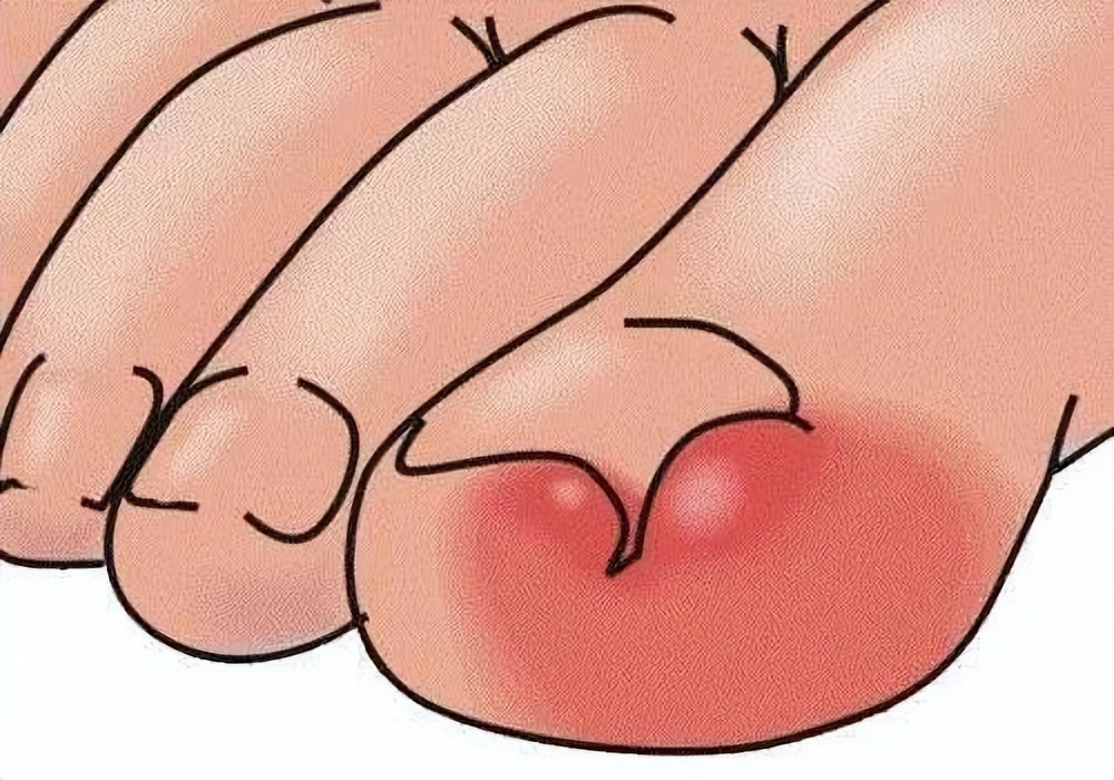 得了甲沟炎的正确处理方法,甲沟炎怎么改掉咬指甲的毛病