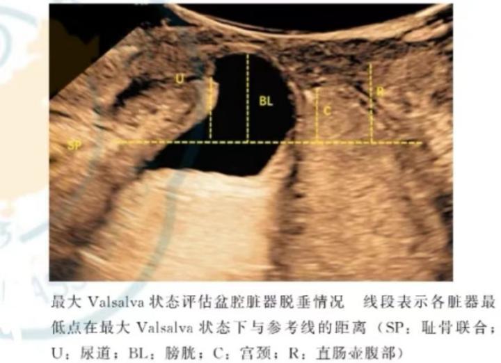 关爱女性健康从关爱女性盆底开始,关爱女性盆底健康图片