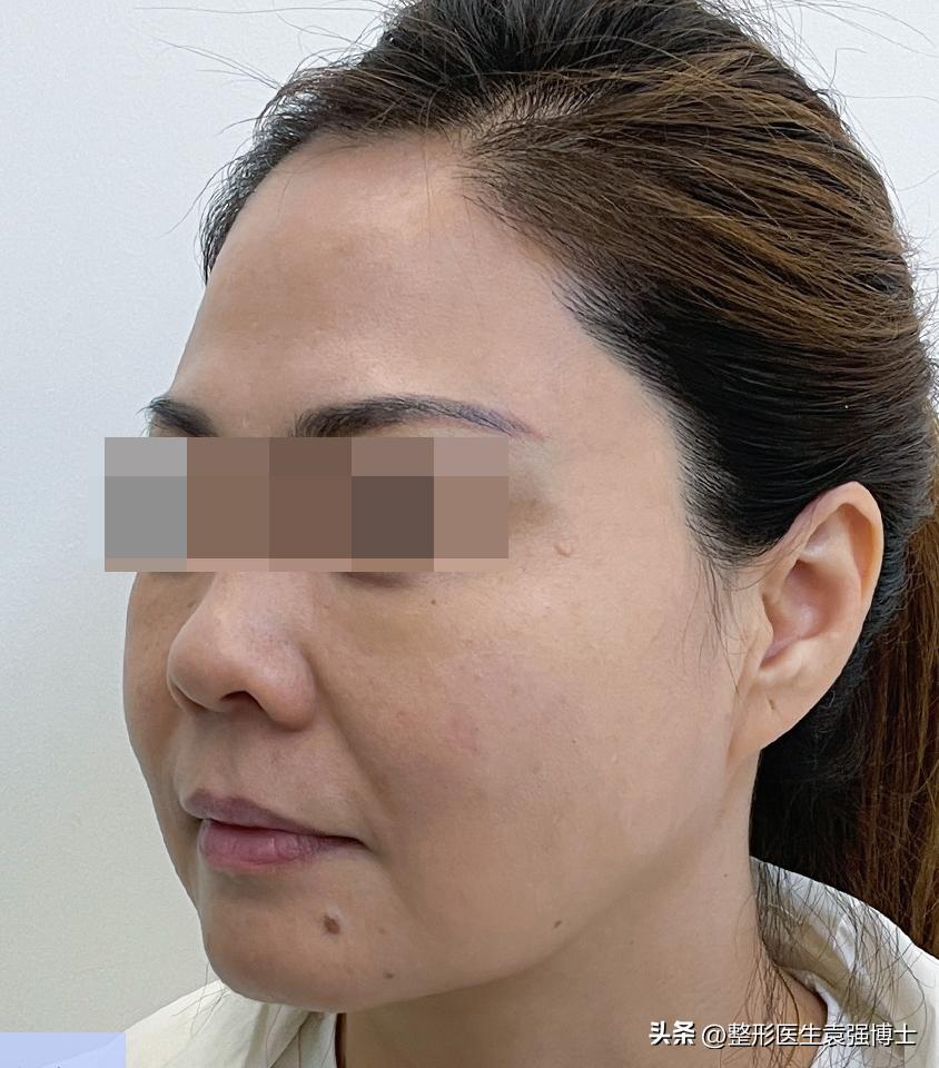 大拉皮多久可以修复大小脸,拉皮改善面部松弛