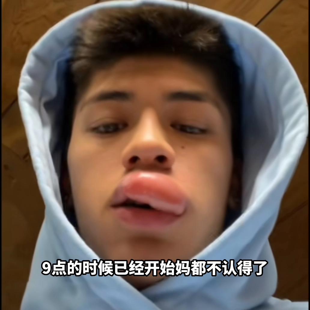 黄蜂蛰了嘴唇为啥越变越大,被黄蜂蛰到嘴唇怎么办