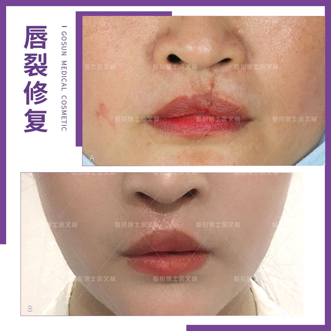 唇裂术后显示红唇缺失,唇裂手术后红唇一侧偏厚正常吗