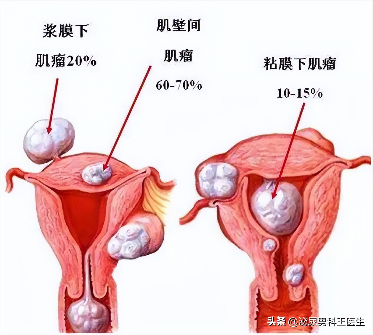 大部分女性都会长子宫肌瘤吗,如何防止长子宫肌瘤