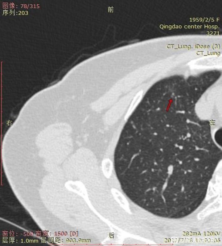 3个月内磨玻璃结节,多发磨玻璃结节3个月后减少