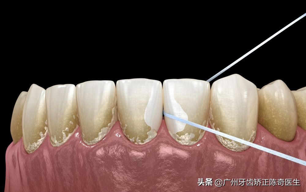 牙结石不处理是不是越长越多,牙结石一个月能长多少