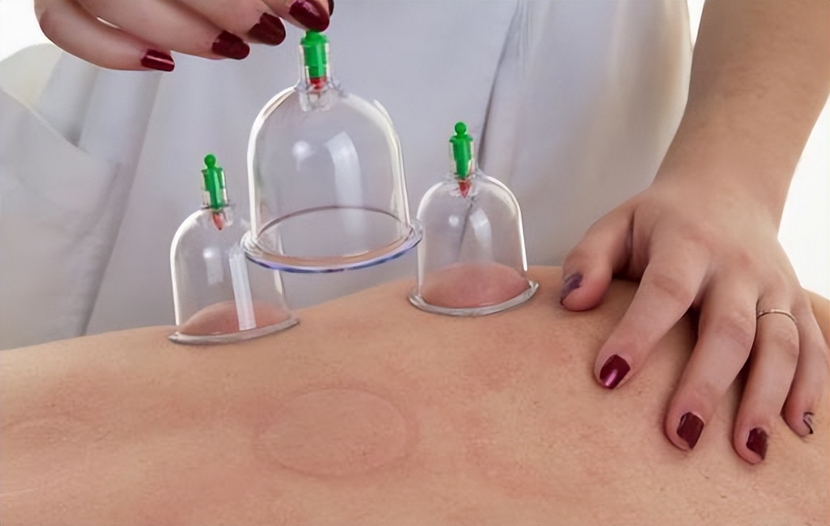 拔火罐吸出来的是湿气还是毒素,拔火罐吸出来的瘀血是体内毒素吗