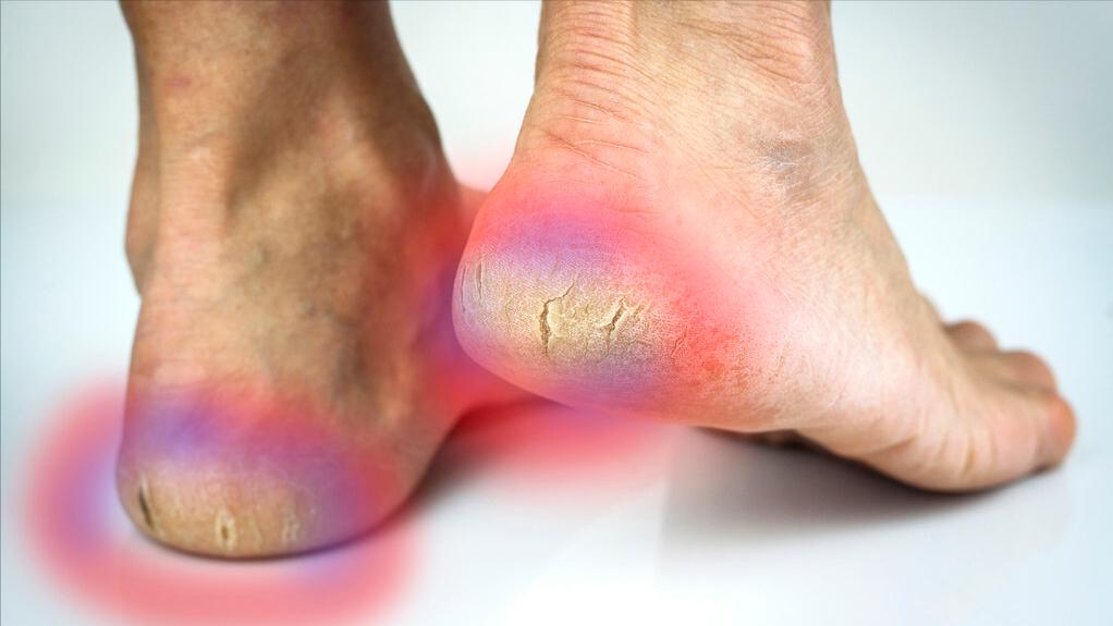 脚后跟干裂是什么原因造成的,为什么脚后跟容易干裂如何应对