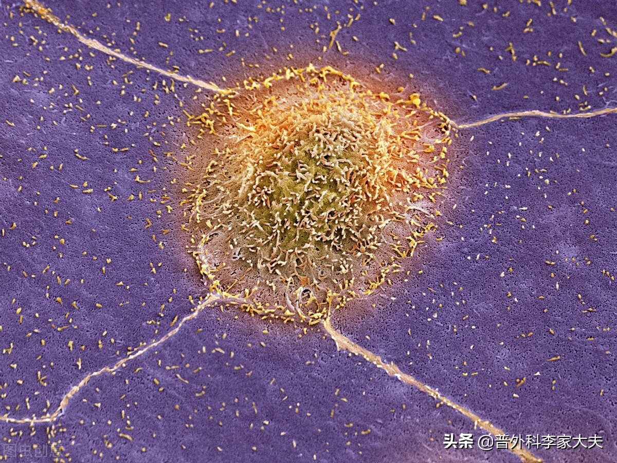 直肠腺癌2-3cm保肛成功率,直肠腺癌低位保肛手术
